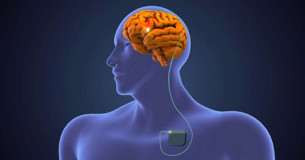 Imagem mostrando um DBS no cérebro do paciente