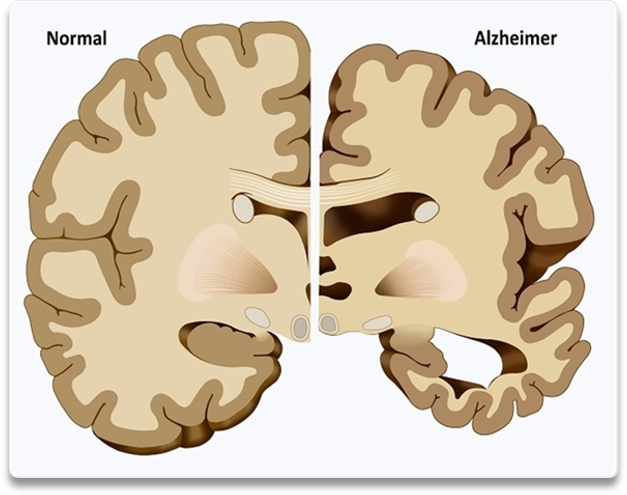 Diminuição do cérebro de uma pessoa com Alzheimer comparado com um cérebro normal
