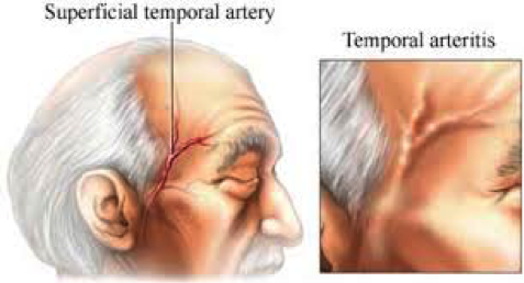 Imagem que mostra localização da artéria temporal e a artéria espessada na arterite temporal