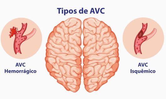 Cérebro e imagem mostrando o AVC isquêmico e hemorrágico