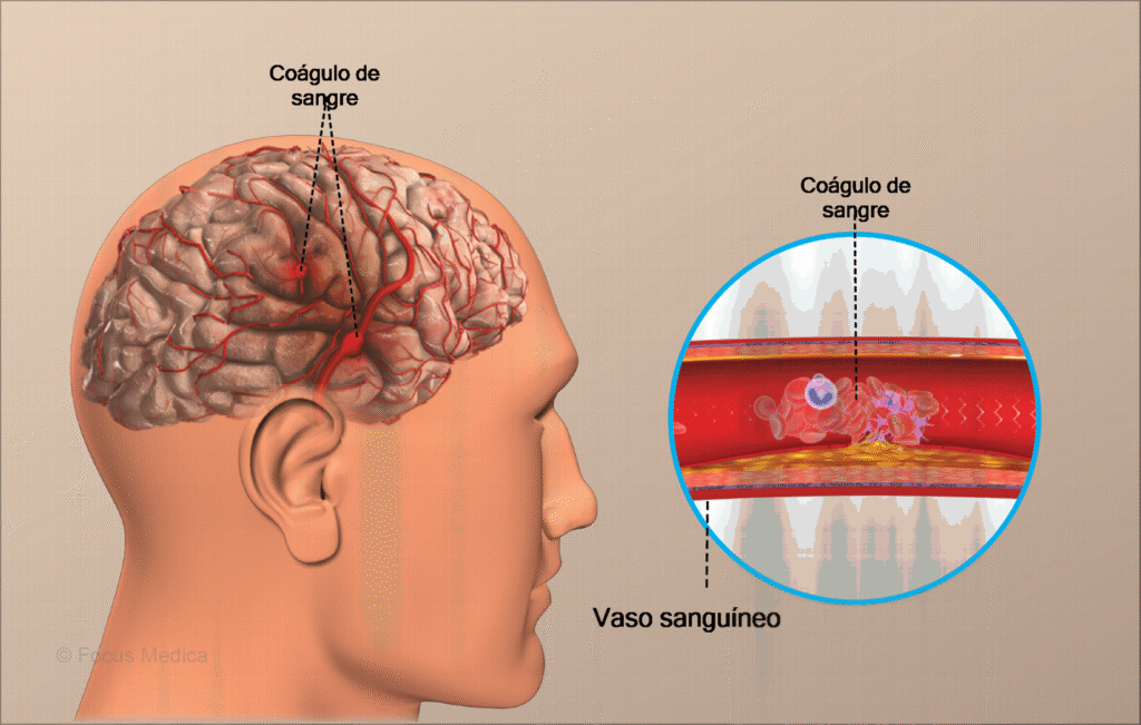 Imagem de um AVC isquêmico, representando a demência vascular