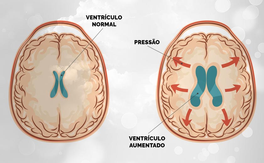 Imagem que mostra como é a hidrocefalia no cérebro