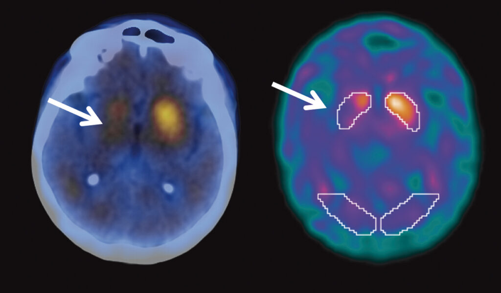 Imagem de SPECT com TRODAT de paciente com parkinson