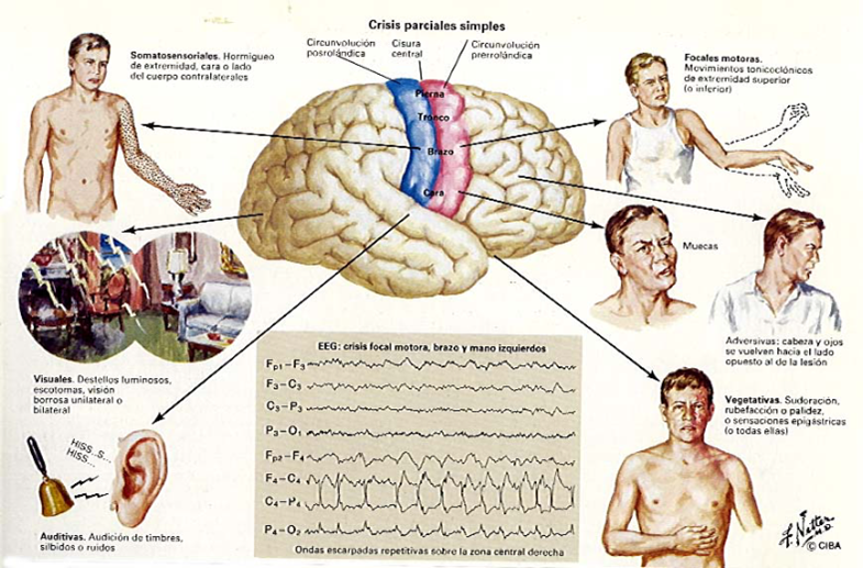 Sintomas de convulsão dependendo da localização no cérebro