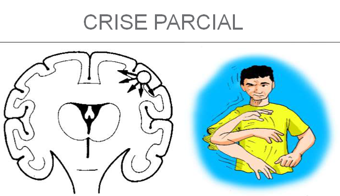 Imagem que mostra como é uma crise focal em uma pessoa e no cérebro