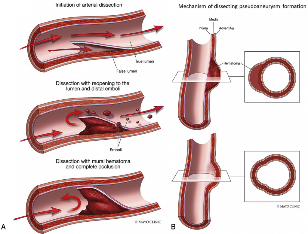 Imagem que mostra como é a dissecção arterial