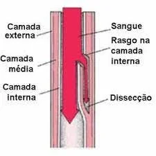 Imagem que mostra como é a dissecção arterial
