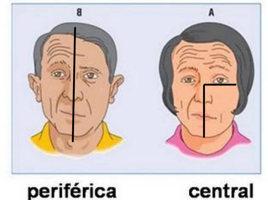 Diferença da paralisia facial do AVC e da de Bell (periférica)
