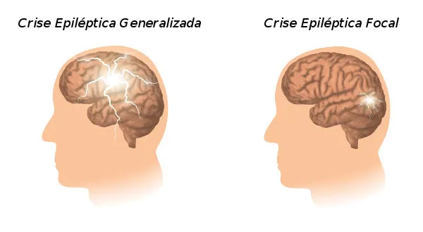 Imagem de um cérebro com crise focal e generalizada