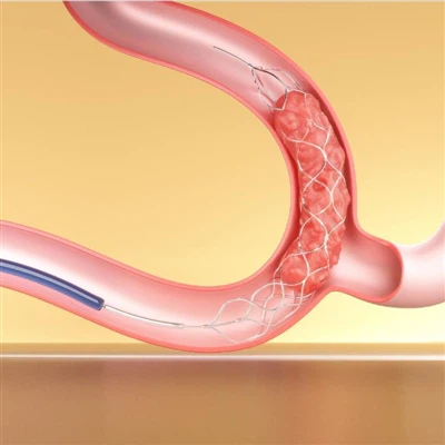 Imagem de trombectomia mecânica para tratamento de AVC