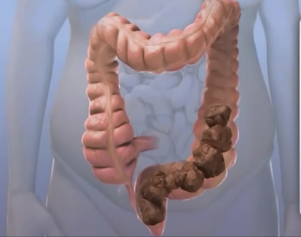 Imagem do intestino preso cheio de fezes