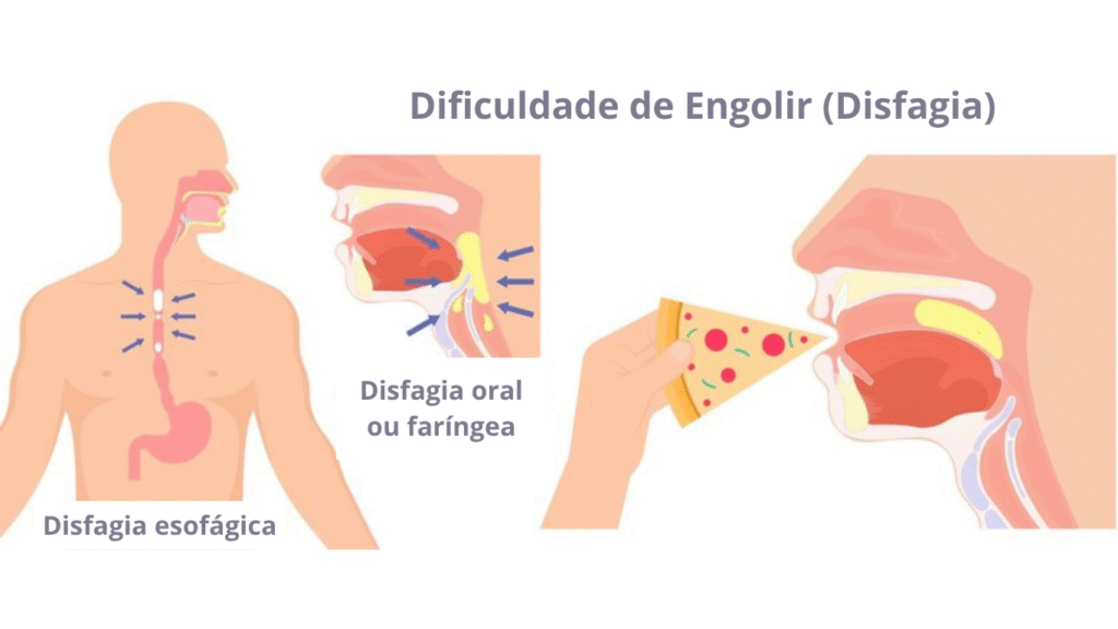 Imagem que ilustra o que é disfagia