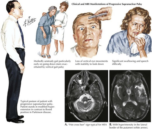 Imagem que mostra alterações da Paralisia Supranuclear Progressiva