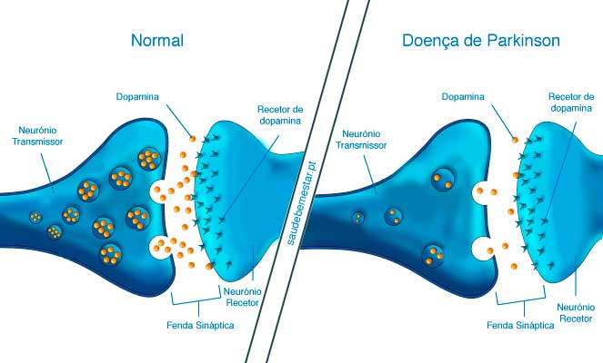 Imagem da redução de dopamina nos neurônios do paciente com parkinson