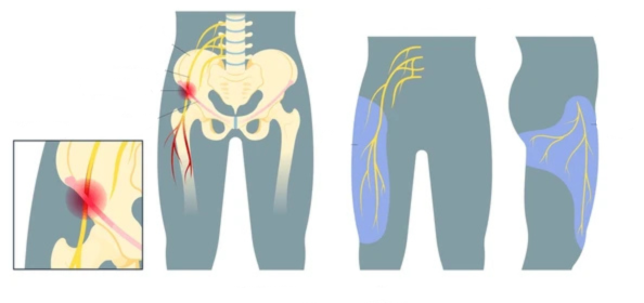 imagem que mostra a localização da lesão na meralgia parestésica e a região que fica com formigamento