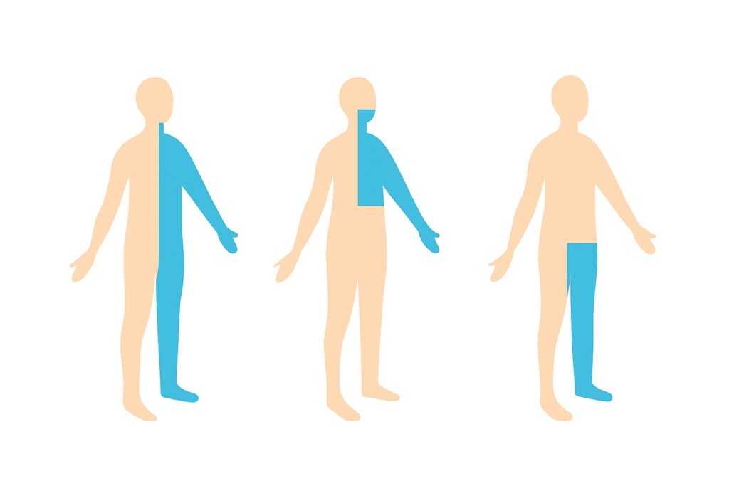 Imagem que mostra como é a dormência em AVC