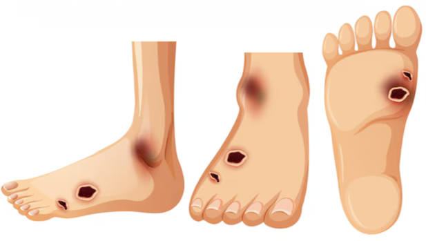 Pé diabético com feridas por falta de sensibilidade e alteração de circulação
