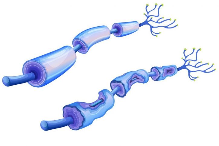Imagem de um nervo com lesões