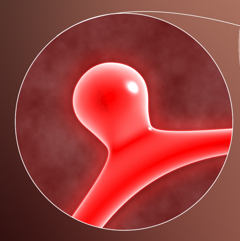 Desenho de um aneurisma não roto