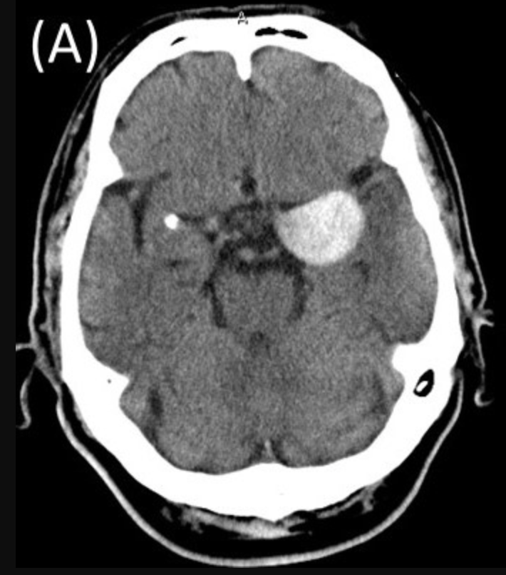 AngioTC mostrando um aneurisma cerebral