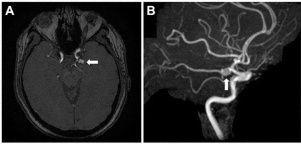 AngioRM mostrando um aneurisma cerebral