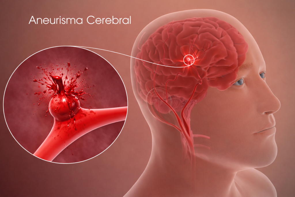 Imagem mostrando um aneurisma cerebral roto no cérebro
