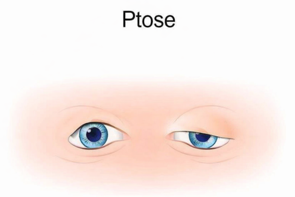 Ilustração de ptose palpebral