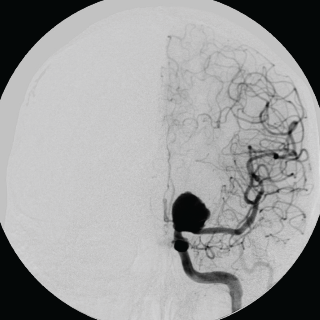 Angiografia cerebral mostrando aneurisma