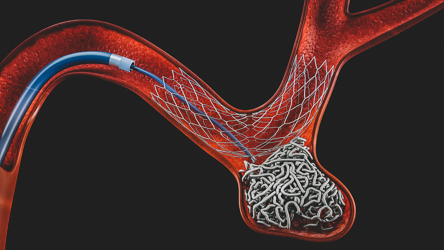 Imagem demonstrando uma embolização de aneurisma